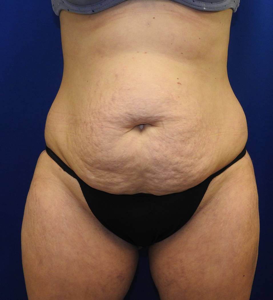 Abdominoplasty Before & After Photos