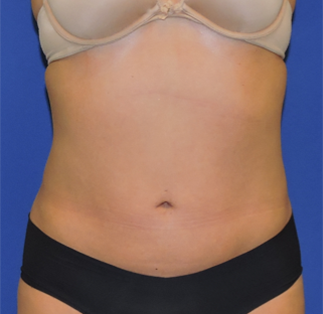Abdominoplasty Before & After Results